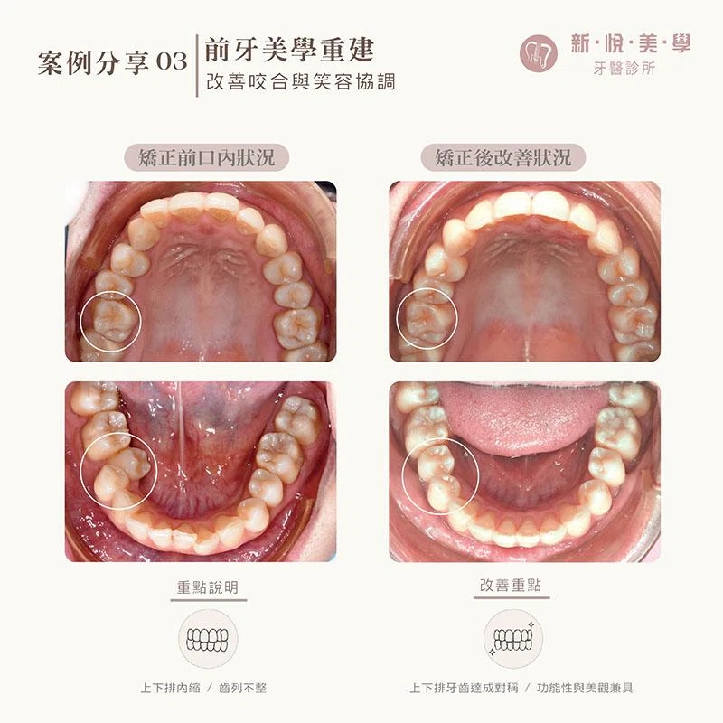 不拔牙矯正可以改善下排牙齒內縮嗎?戴蒙矯正案例分享 不拔牙矯正可以改善下排牙齒內縮嗎?戴蒙矯正案例分享