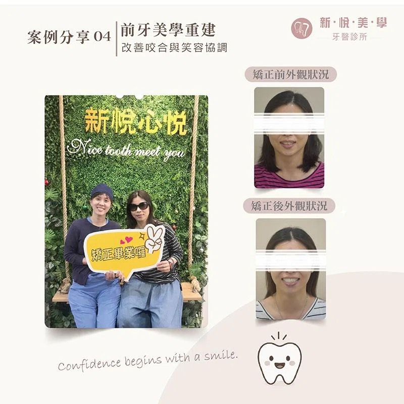 不拔牙矯正可以改善下排牙齒內縮嗎?戴蒙矯正案例分享 不拔牙矯正可以改善下排牙齒內縮嗎?戴蒙矯正案例分享