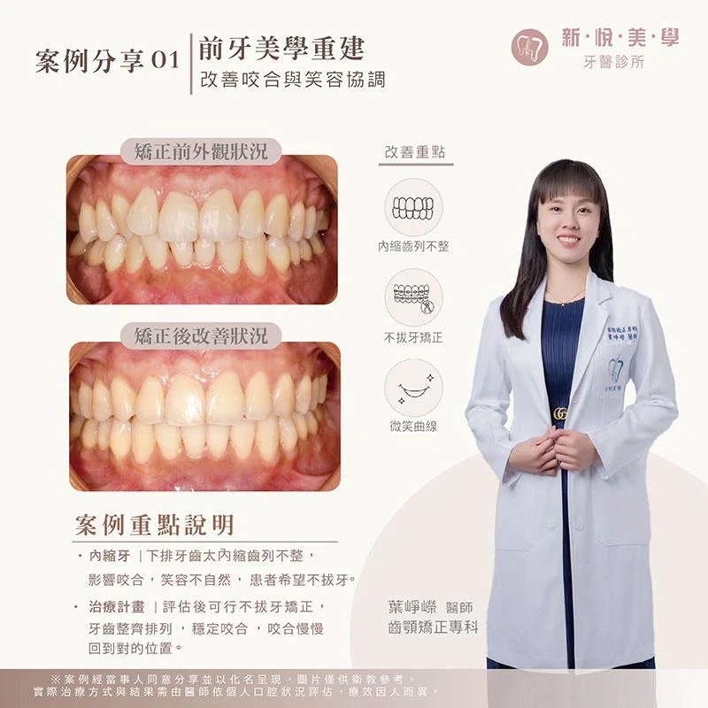 不拔牙矯正可以改善下排牙齒內縮嗎？戴蒙矯正案例分享