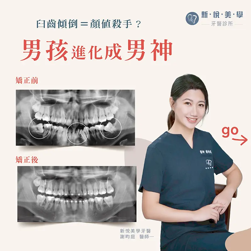 透明牙套矯正優點大公開，沒人看得出來的自信蛻變