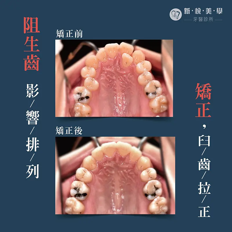 透明牙套矯正優點大公開，沒人看得出來的自信蛻變