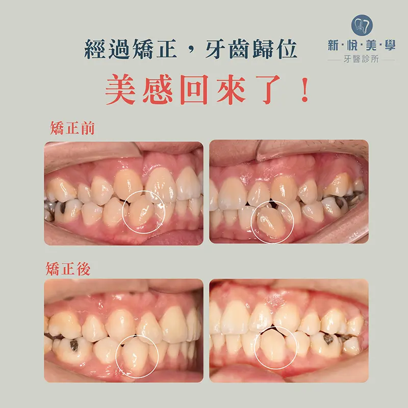 透明牙套矯正優點大公開，沒人看得出來的自信蛻變