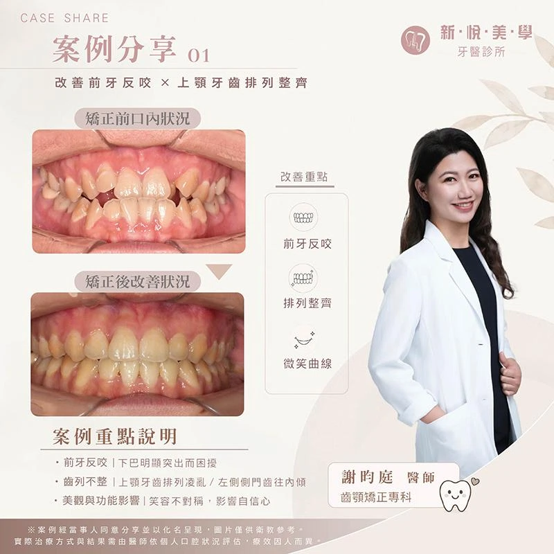 前牙反咬＋齒列凌亂，矯正如何兼顧笑容與咬合？