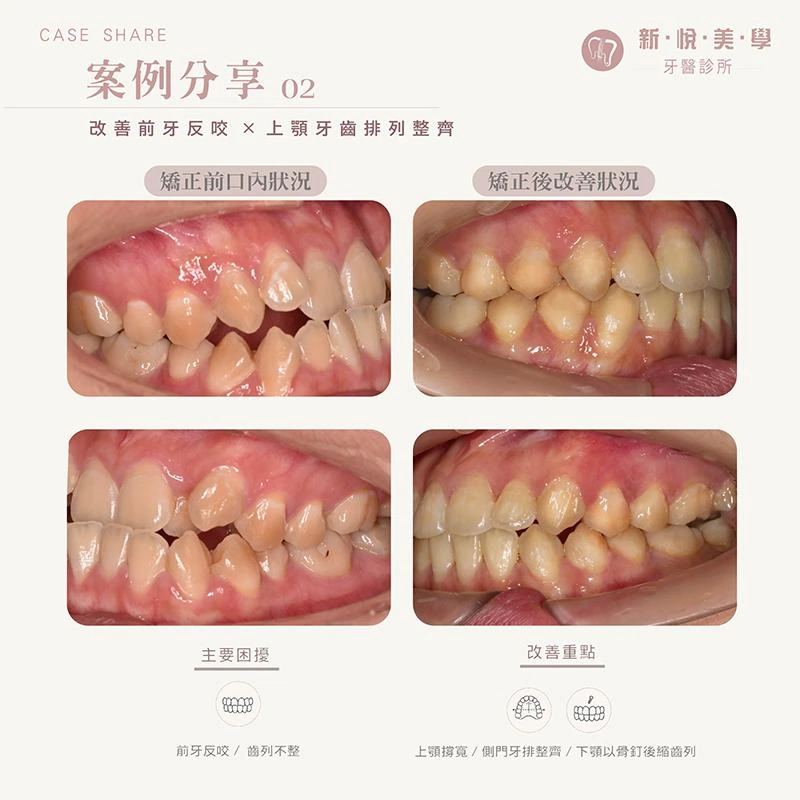 前牙反咬+齒列凌亂,矯正如何兼顧笑容與咬合? 前牙反咬+齒列凌亂,矯正如何兼顧笑容與咬合?