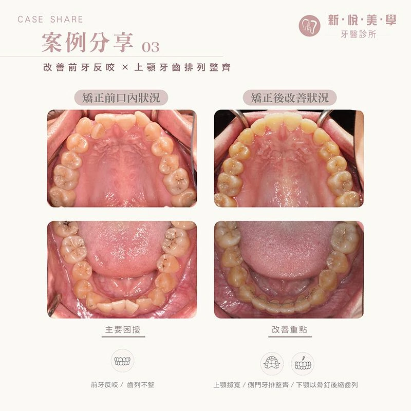 前牙反咬+齒列凌亂,矯正如何兼顧笑容與咬合? 前牙反咬+齒列凌亂,矯正如何兼顧笑容與咬合?