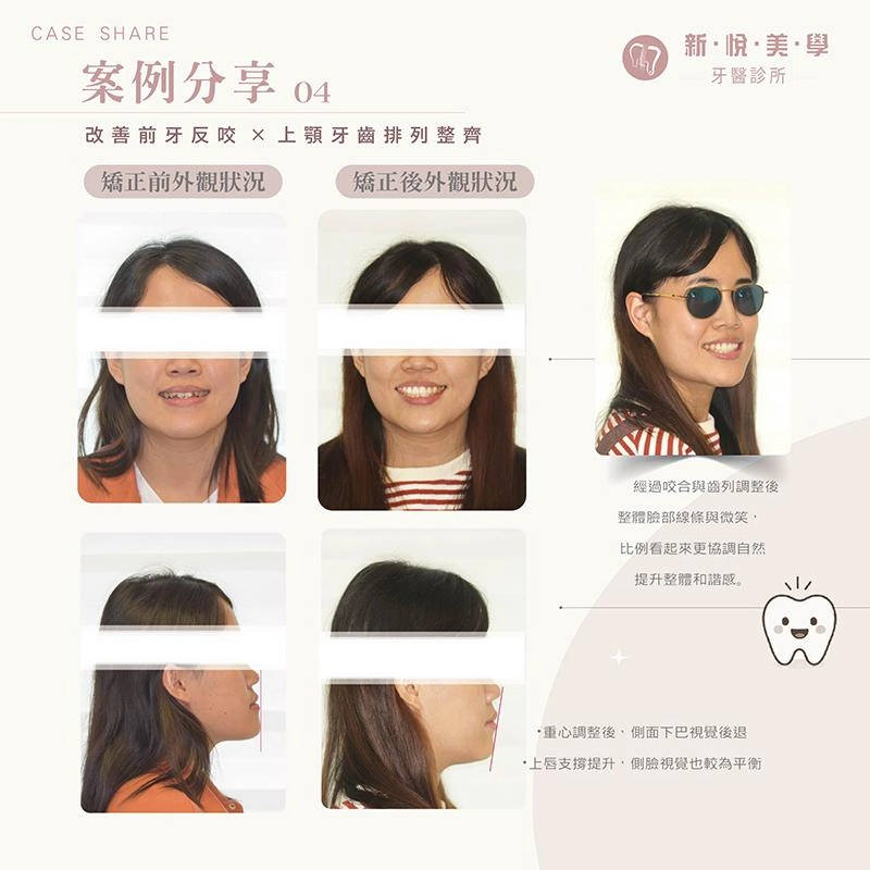 前牙反咬+齒列凌亂,矯正如何兼顧笑容與咬合? 前牙反咬+齒列凌亂,矯正如何兼顧笑容與咬合?