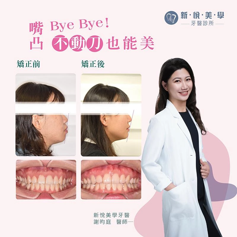 看似完美牙齒的矯正案例｜嘴凸與雙顎骨前突改善
