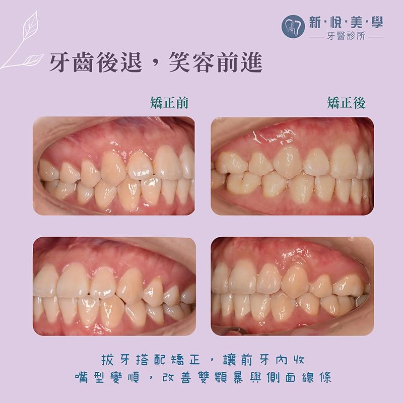 看似完美牙齒的矯正案例｜嘴凸與雙顎骨前突改善