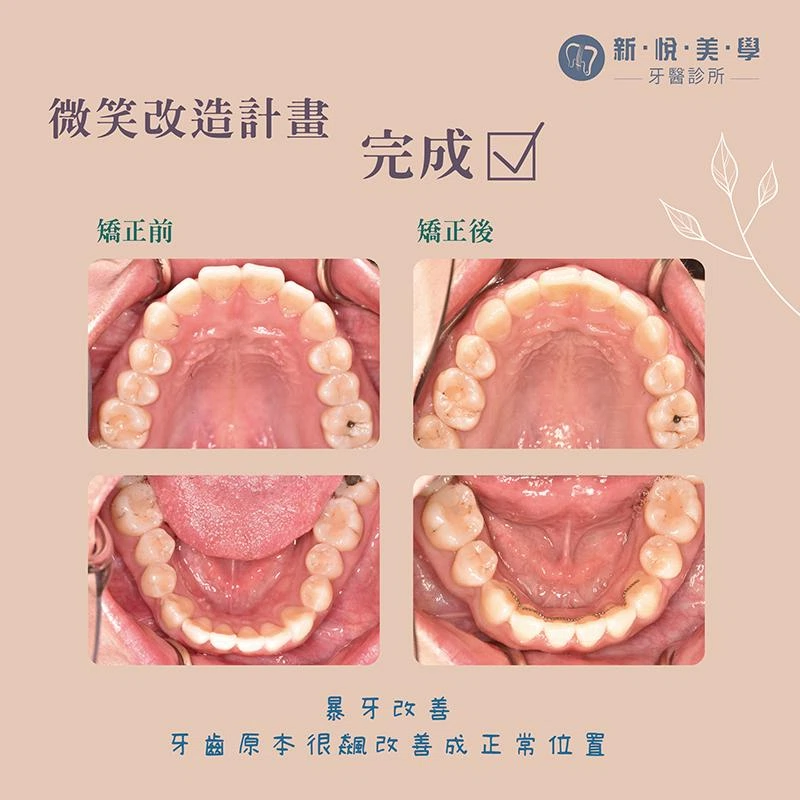 看似完美牙齒的矯正案例｜嘴凸與雙顎骨前突改善