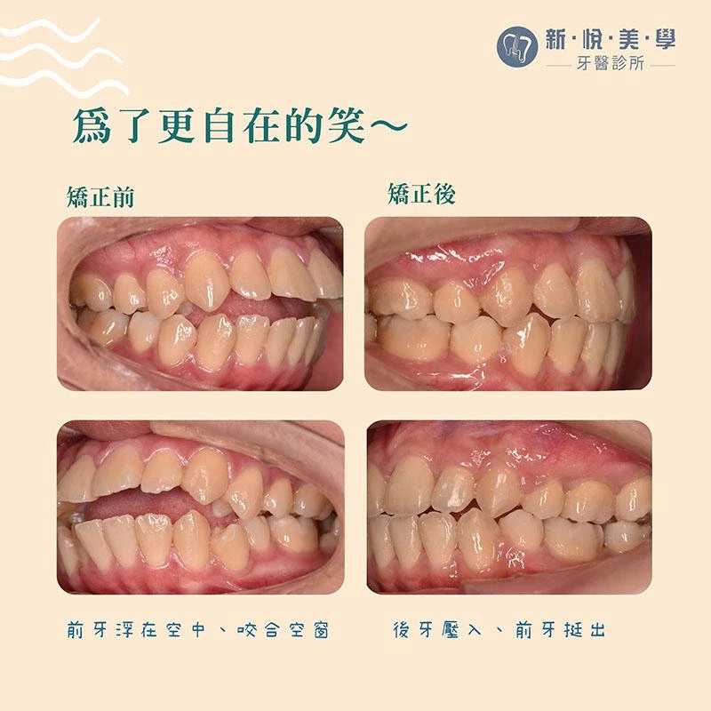 咬筆、吃軟糖竟造成顳顎關節疼痛? 咬筆、吃軟糖竟造成顳顎關節疼痛?