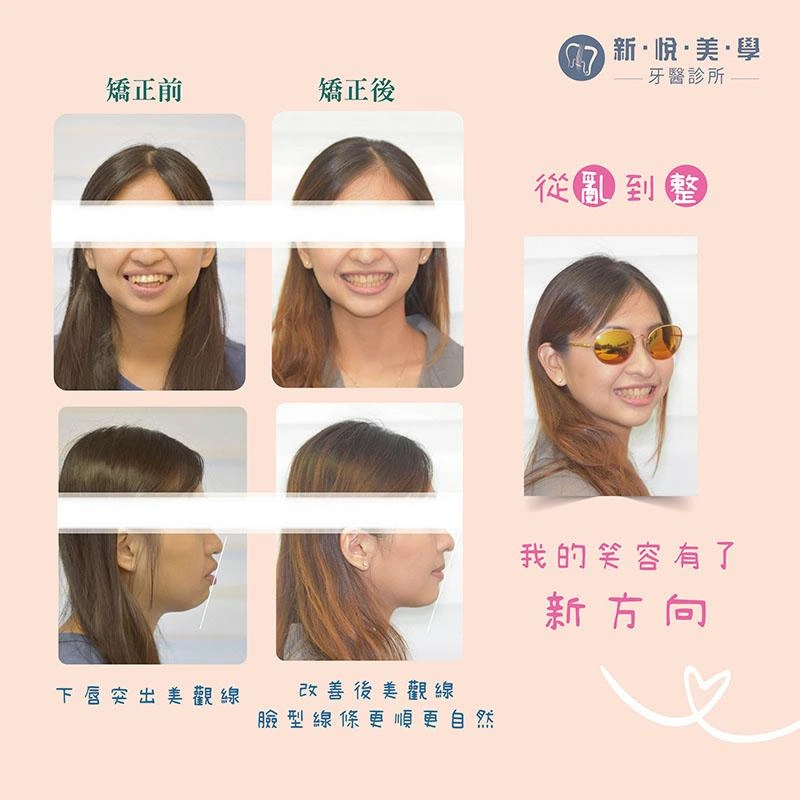 咬筆、吃軟糖竟造成顳顎關節疼痛? 咬筆、吃軟糖竟造成顳顎關節疼痛?