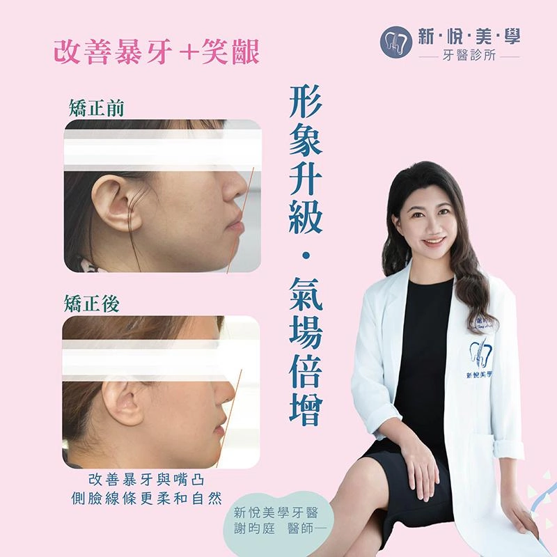 改善笑齦明顯、嘴凸矯正、形象升級．氣場倍增