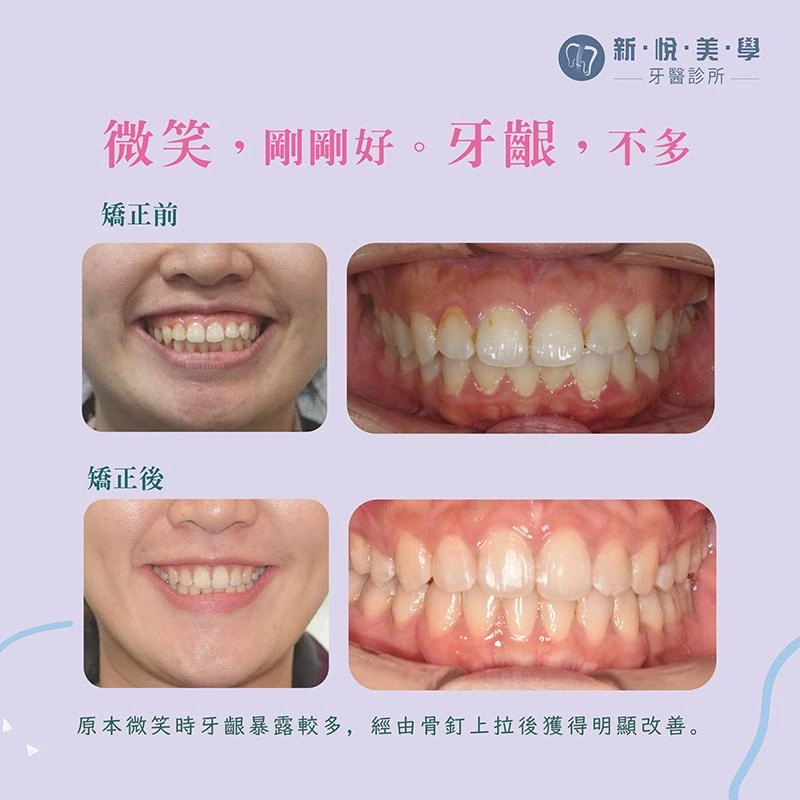 改善笑齦明顯、嘴凸矯正、形象升級．氣場倍增