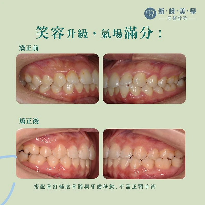 改善笑齦明顯、嘴凸矯正、形象升級．氣場倍增