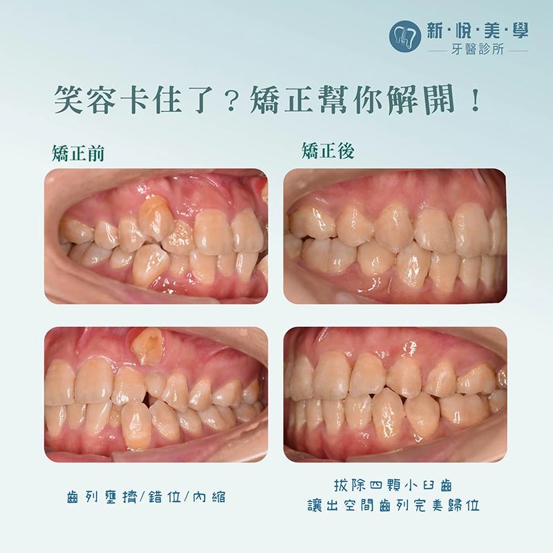 告別沙丁魚派對，矯正後的驚人改變