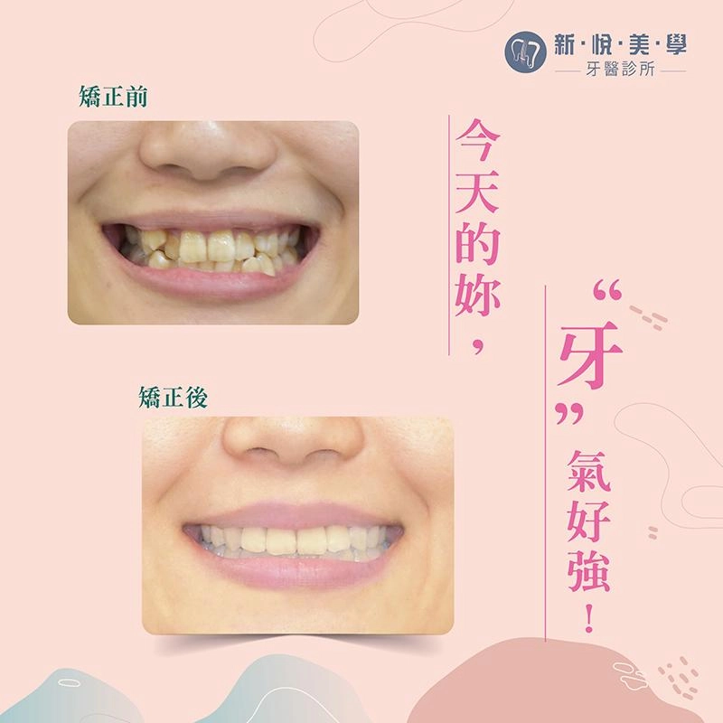 告別沙丁魚派對，矯正後的驚人改變