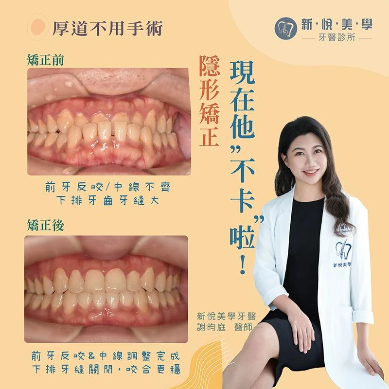 厚道不用手術｜前牙反咬與齒列擁擠的隱形矯正改善