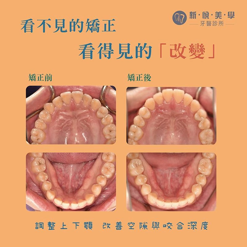 厚道不用手術｜前牙反咬與齒列擁擠的隱形矯正改善