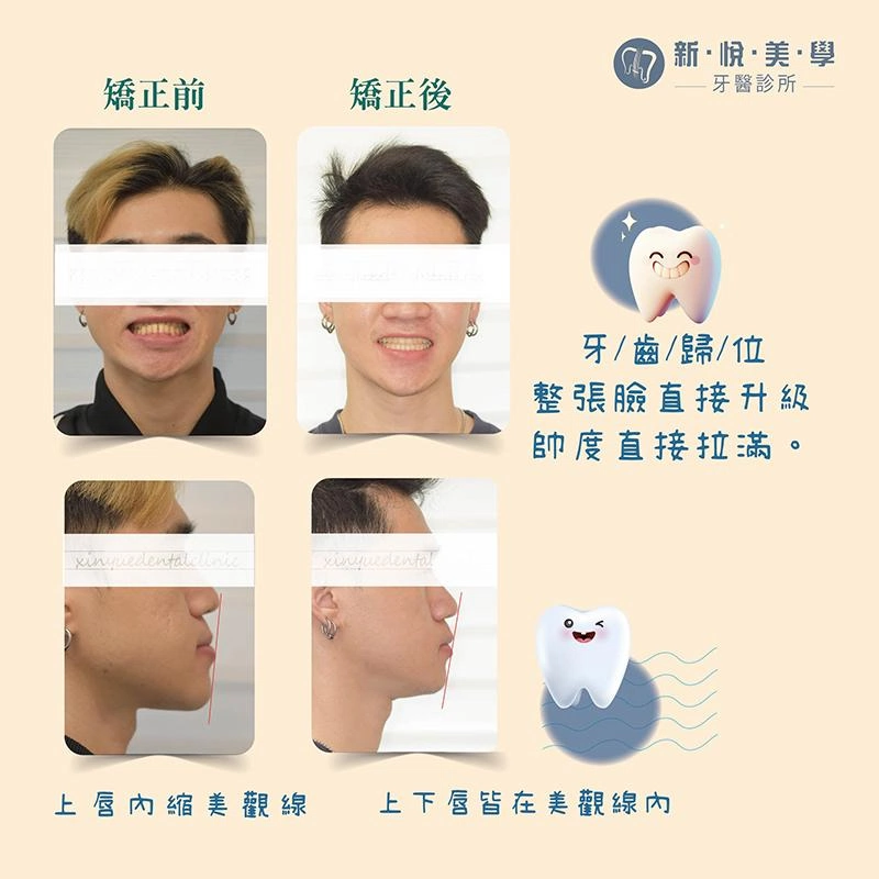厚道不用手術｜前牙反咬與齒列擁擠的隱形矯正改善