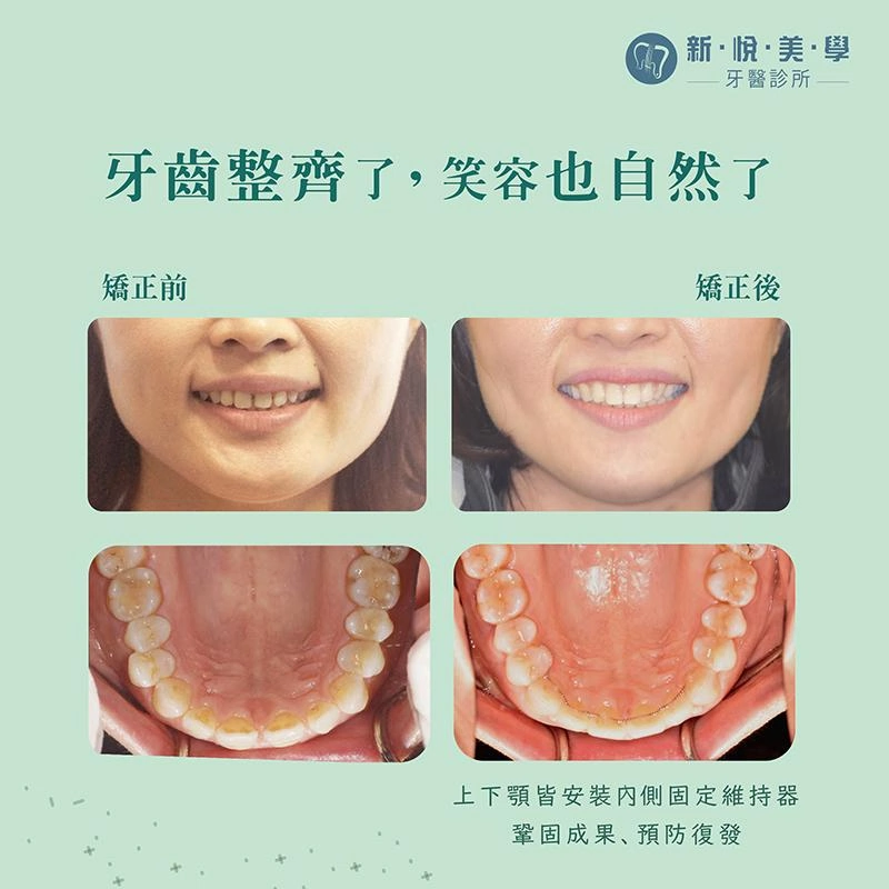 咬合穩了，笑容就穩了，就是職場的力量