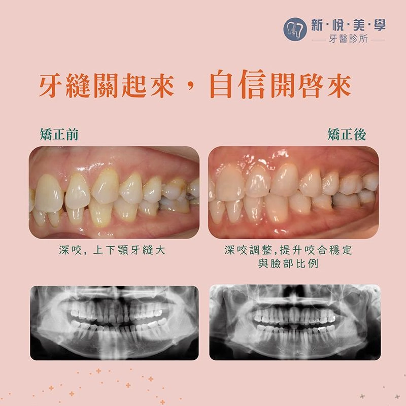 咬合穩了，笑容就穩了，就是職場的力量