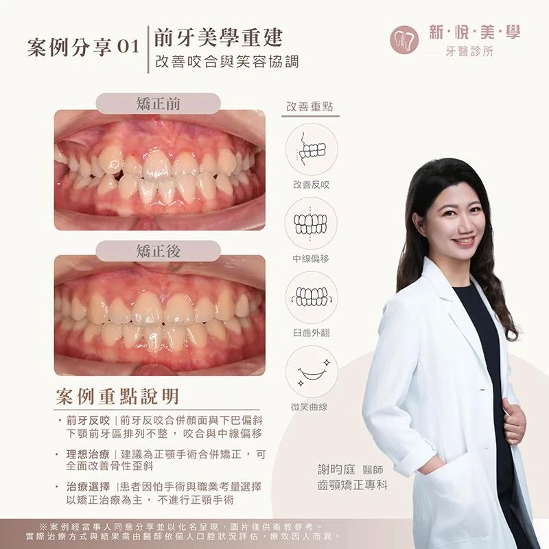前牙反咬、牙齒凌亂，矯正如何重新調整笑容？