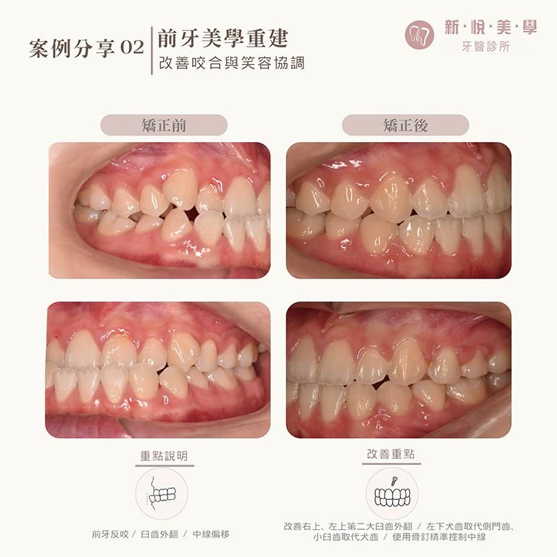 前牙反咬、牙齒凌亂,矯正如何重新調整笑容? 前牙反咬、牙齒凌亂,矯正如何重新調整笑容?