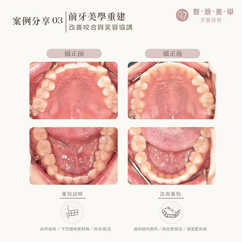 前牙反咬、牙齒凌亂,矯正如何重新調整笑容? 前牙反咬、牙齒凌亂,矯正如何重新調整笑容?