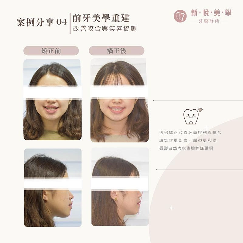 前牙反咬、牙齒凌亂,矯正如何重新調整笑容? 前牙反咬、牙齒凌亂,矯正如何重新調整笑容?