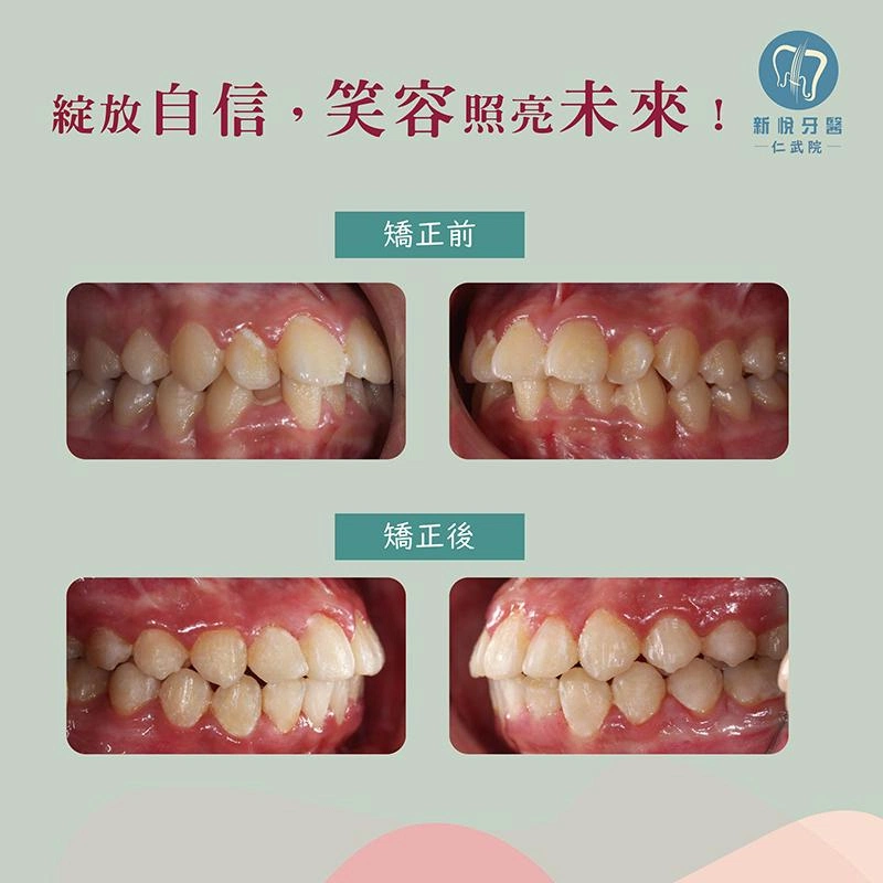 矯正改變人生/從害羞低頭到自信微笑 矯正改變人生/從害羞低頭到自信微笑