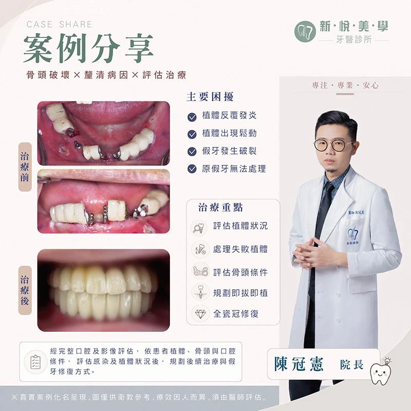 假牙鬆了又裂，原來連 Mini Implant 迷你植體出了問題？