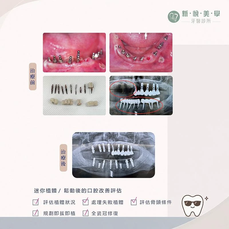 假牙鬆了又裂,原來連 Mini Implant 迷你植體出了問題? 假牙鬆了又裂,原來連 Mini Implant 迷你植體出了問題?