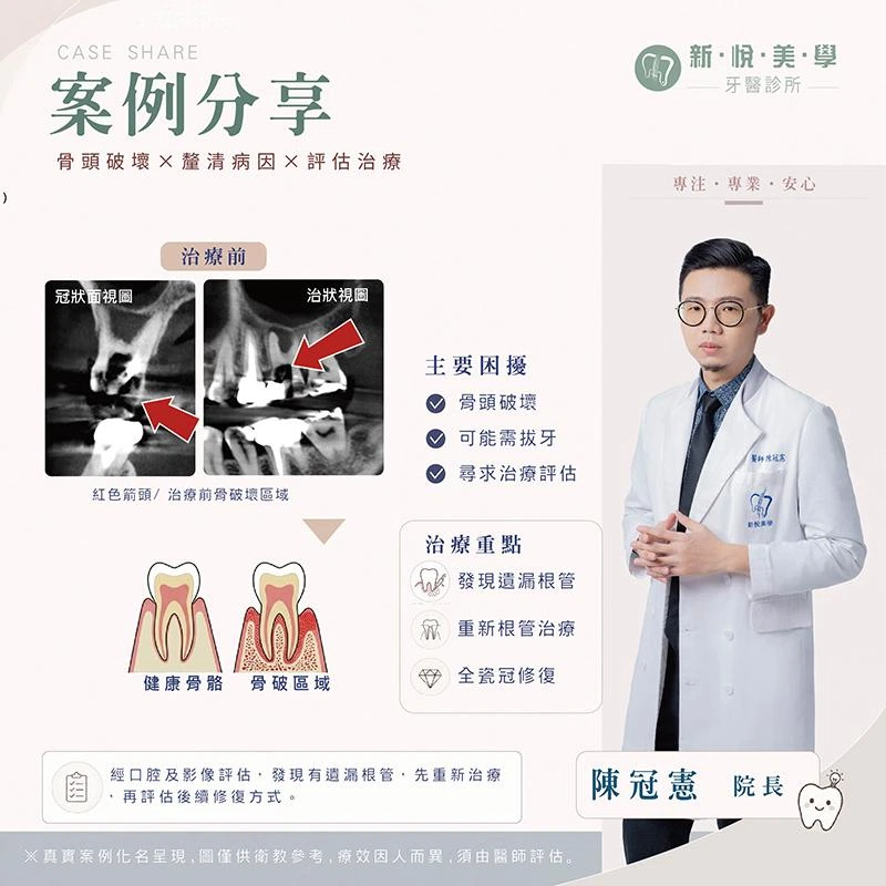 牙齒保不住只能拔？先找出根管裡沒被發現的問題