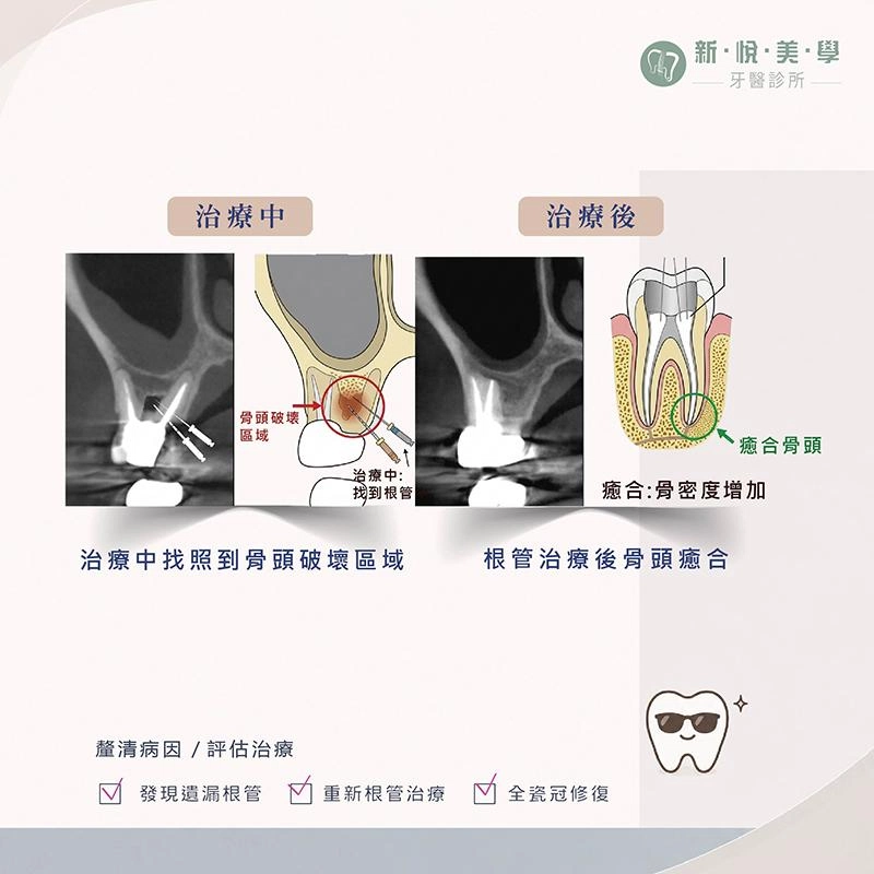 牙齒保不住只能拔?先找出根管裡沒被發現的問題 牙齒保不住只能拔?先找出根管裡沒被發現的問題