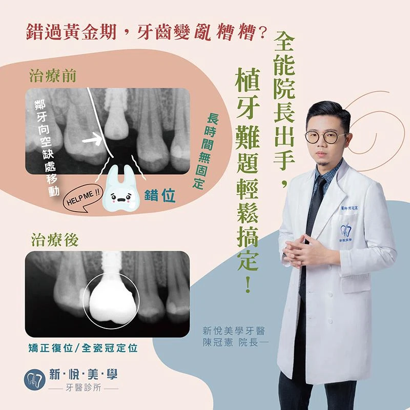 錯過黃金期，牙齒變亂糟糟？全能院長出手，植牙難題輕鬆搞定！