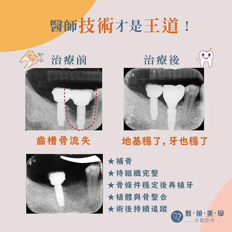 別人的植牙壞掉。骨頭被吃掉。看我如何重建 別人的植牙壞掉。骨頭被吃掉。看我如何重建