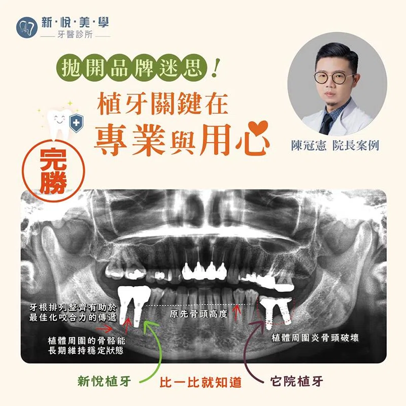 拋開品牌迷思！植牙關鍵在專業與用心