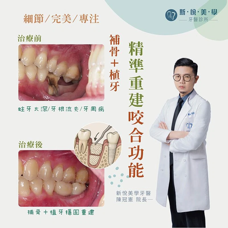 牙周病導致拔牙？補骨植牙一步重建咬合力，阿成重拾咀嚼快感