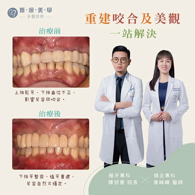 牙齒暴突、上排植牙＋下排矯正一次完成