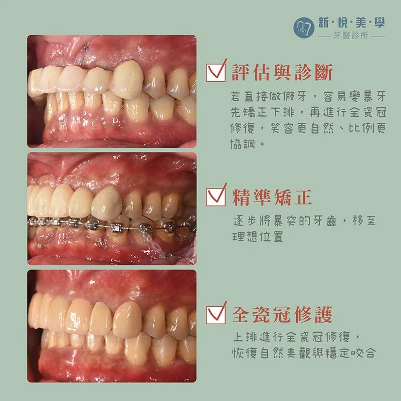 牙齒暴突、上排植牙＋下排矯正一次完成