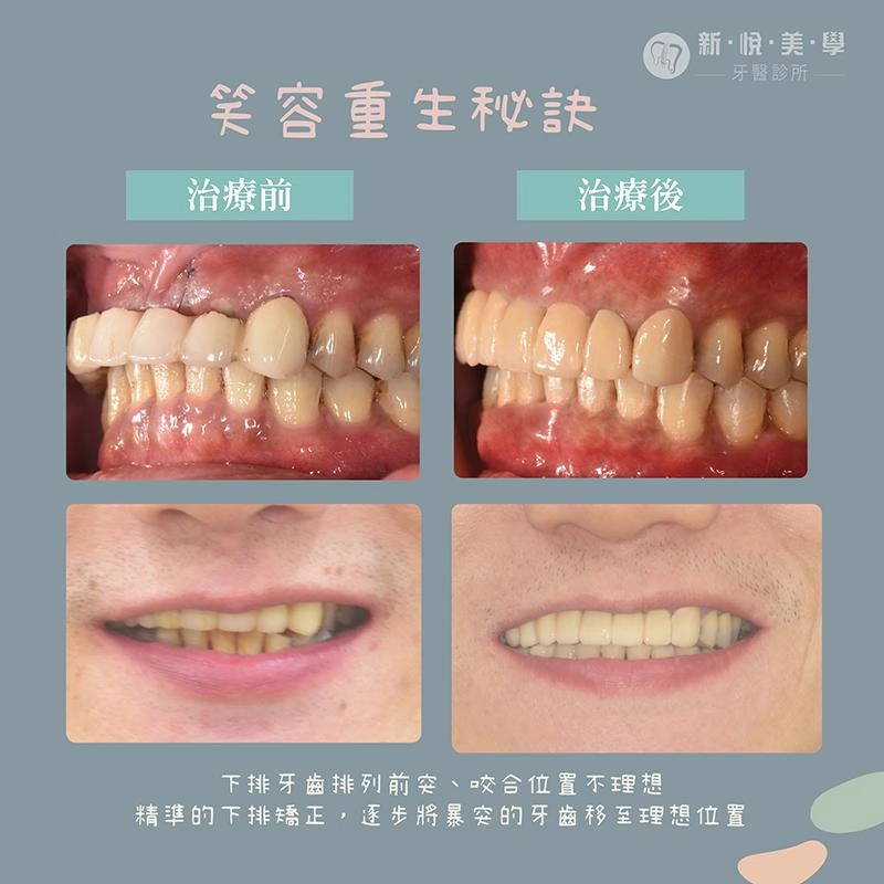 牙齒暴突、上排植牙＋下排矯正一次完成
