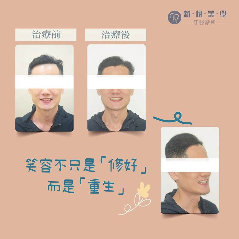 牙齒暴突、上排植牙＋下排矯正一次完成