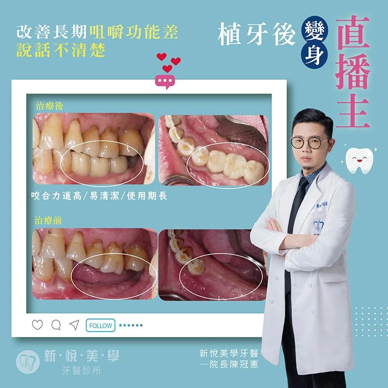 缺牙OUT！財叔植牙後變身直播主