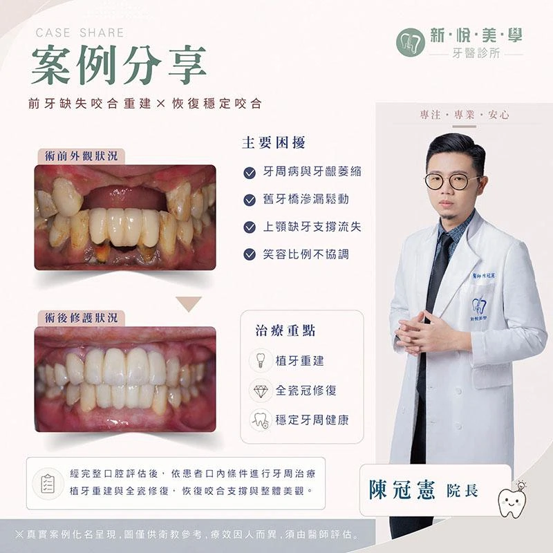 牙齦萎縮、缺牙讓笑容顯老？從牙周治療到植牙重建找回自然笑容