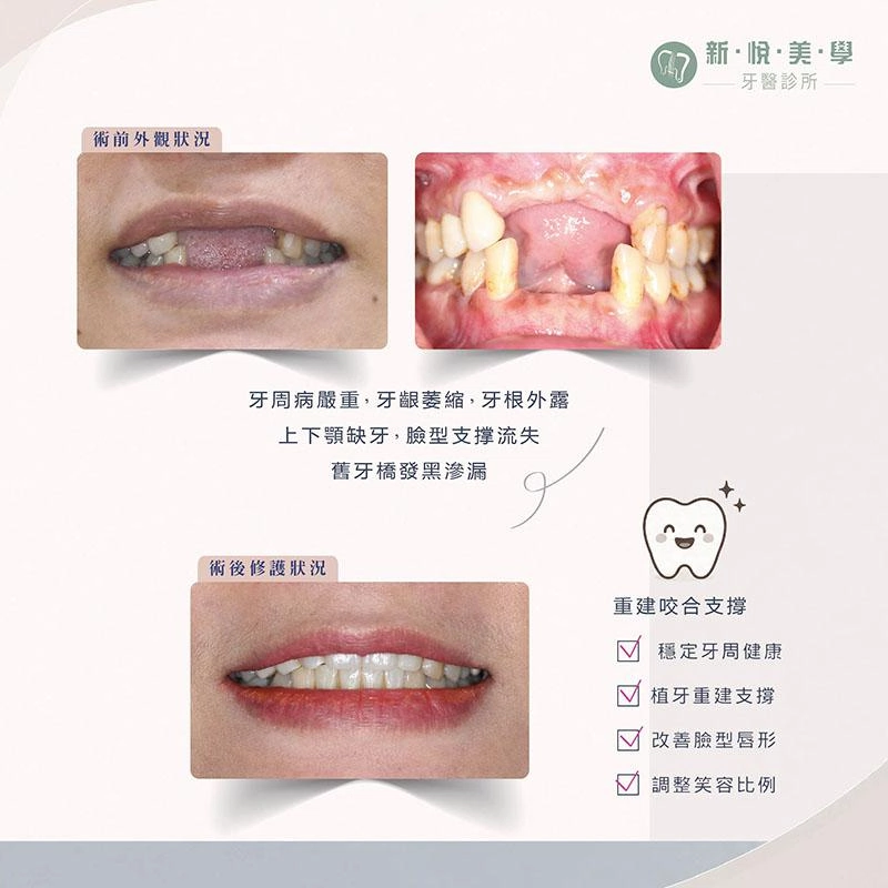 牙齦萎縮、缺牙讓笑容顯老?從牙周治療到植牙重建找回自然笑容 牙齦萎縮、缺牙讓笑容顯老?從牙周治療到植牙重建找回自然笑容
