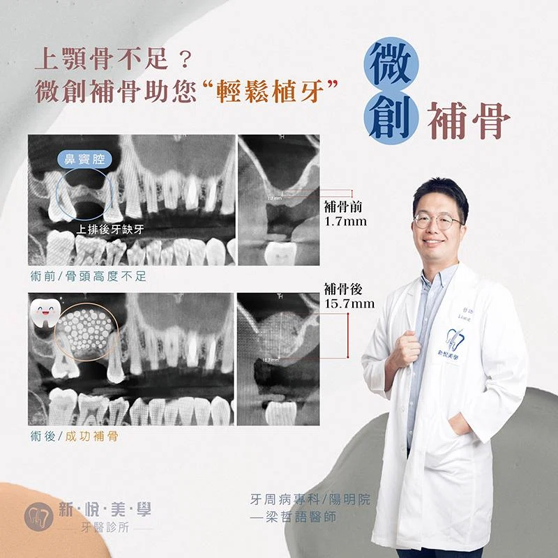傷口小、風險低：微創鼻竇增高助您安心植牙