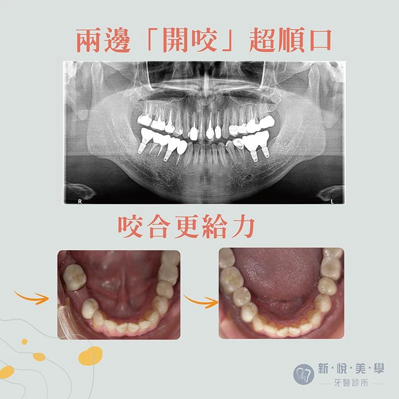 植牙＋全瓷冠重拾暢快咀嚼力，左右都咬得動