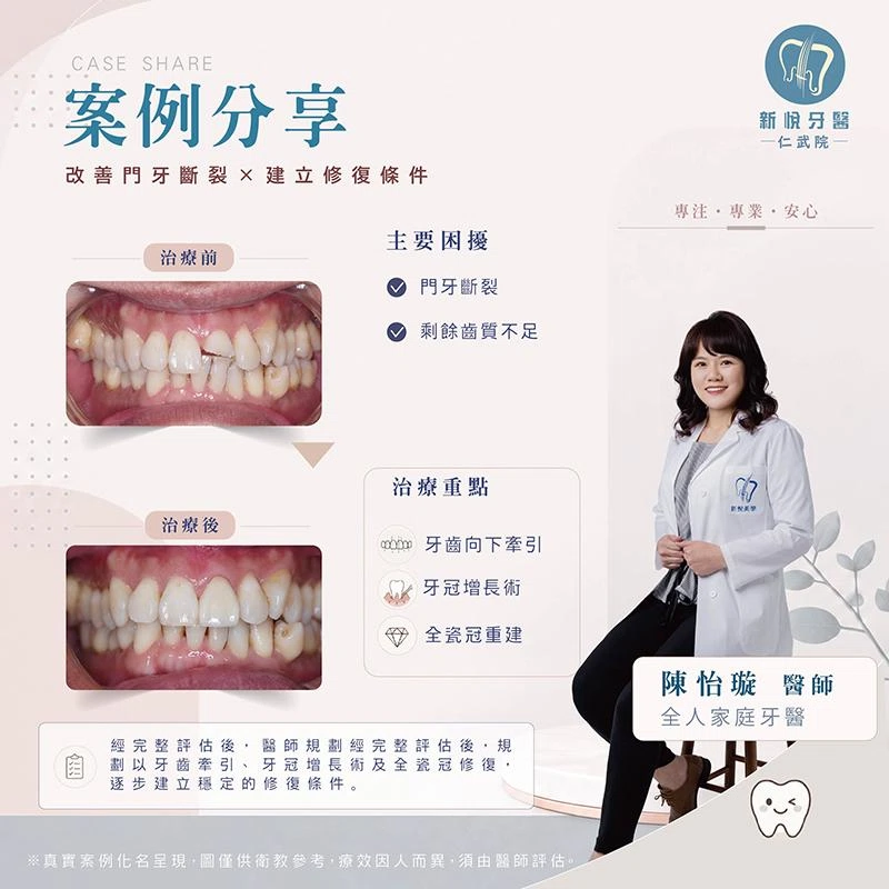 門牙斷裂只能做假牙嗎?牙齒牽引、牙冠增長術與全瓷冠修復 門牙斷裂只能做假牙嗎?牙齒牽引、牙冠增長術與全瓷冠修復