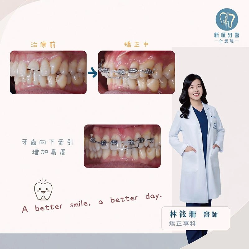 門牙斷裂只能做假牙嗎?牙齒牽引、牙冠增長術與全瓷冠修復 門牙斷裂只能做假牙嗎?牙齒牽引、牙冠增長術與全瓷冠修復