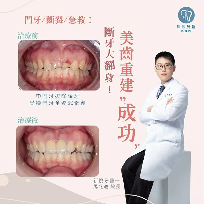 門牙斷裂怎麼辦？植牙＋全瓷冠重建，笑容自然回來